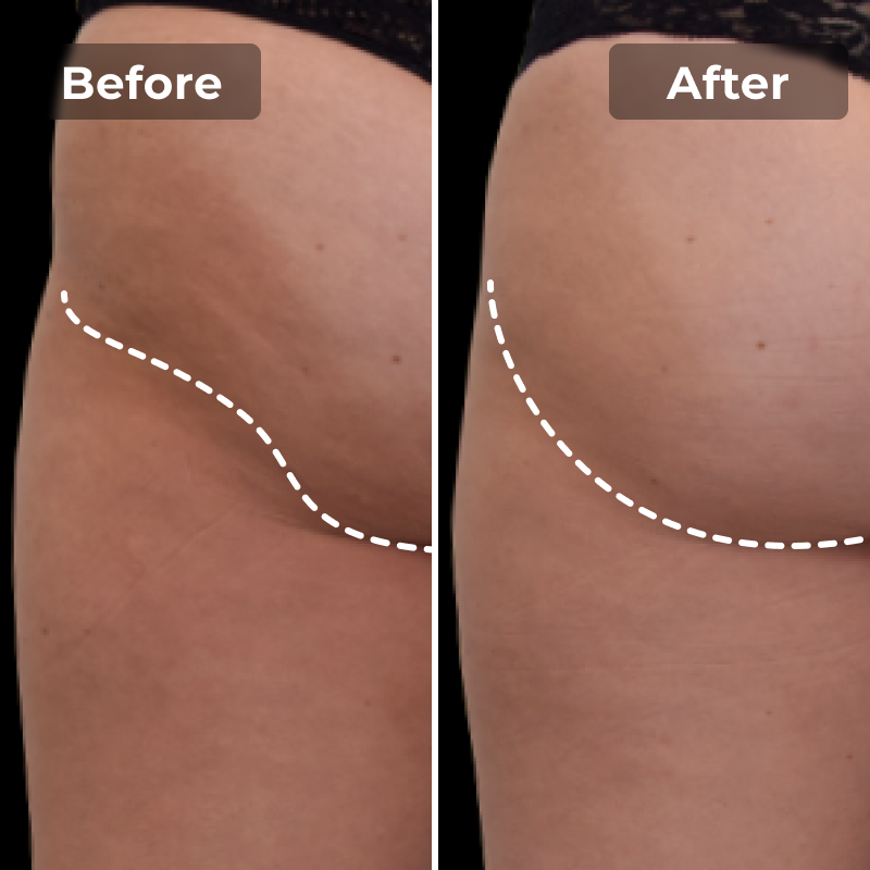 Malkiwi EMS Toning Shorts